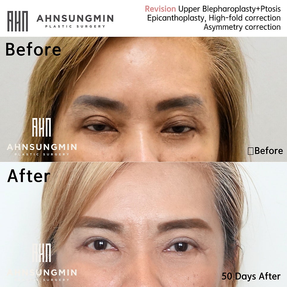 눈재수술전문 안성민성형외과 눈매교정재수술 안성민성형외과 관련 이미지 2