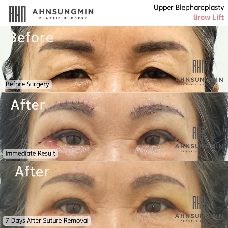 눈썹상거상 수술과 회복기간 관련 이미지 2