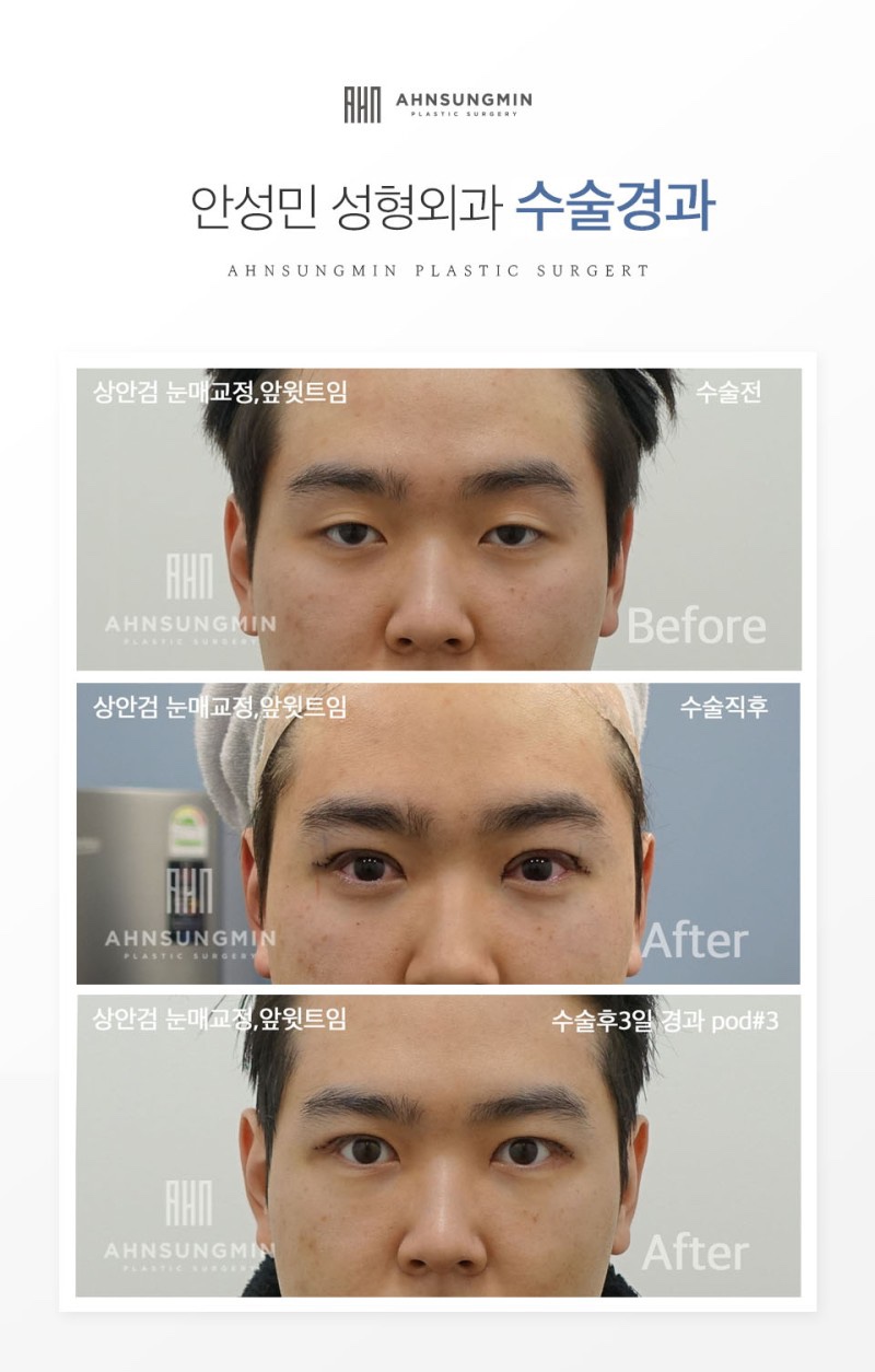 하안검수술 상안검수술 비교해보자면 관련 이미지 6