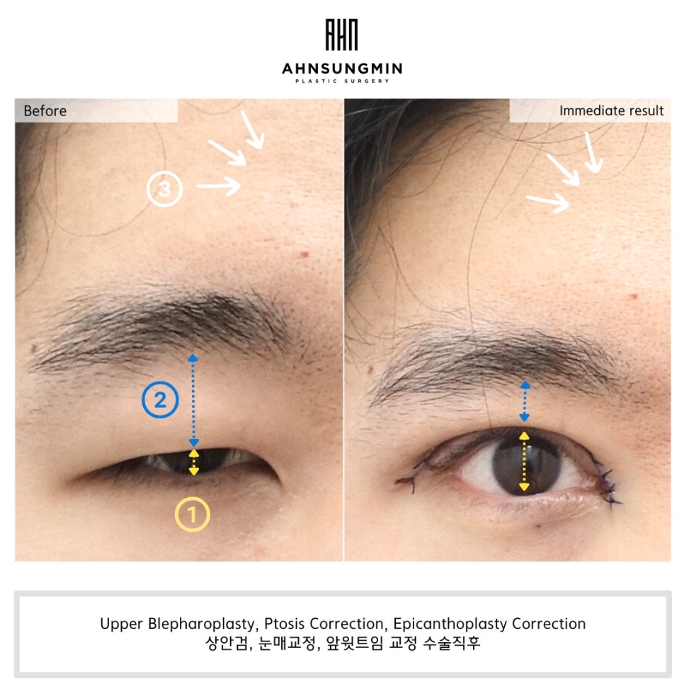 20대 남자 눈매교정 수술 직후 눈동자 노출 변화 관련 이미지 4