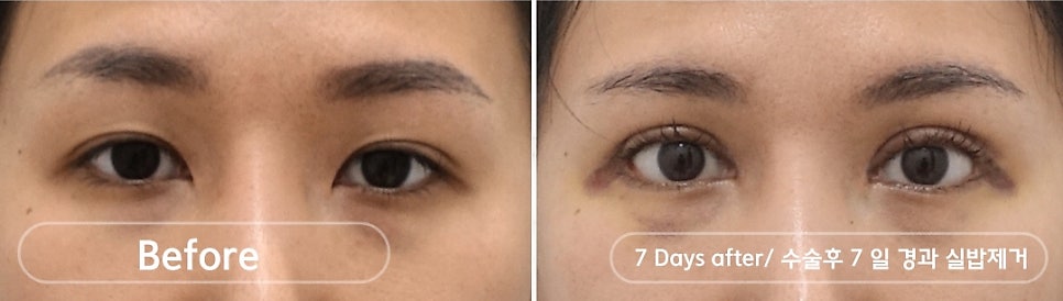 나이대별 상안검 수술, 처진 눈꺼풀을 개선하다 관련 이미지 3