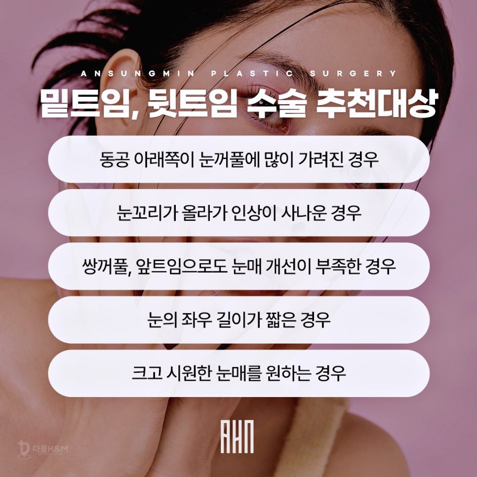 성형외과전문의 안성민이 말하는 트임수술 관련 이미지 6