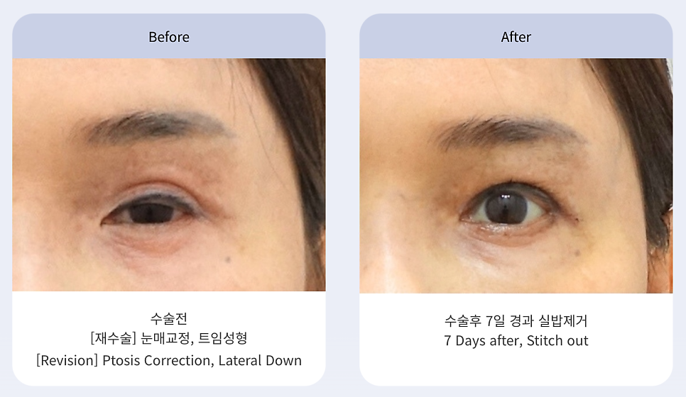 트임 성형의 모든 것 뒤트임, 뒷내림, 밑트임 관련 이미지 3