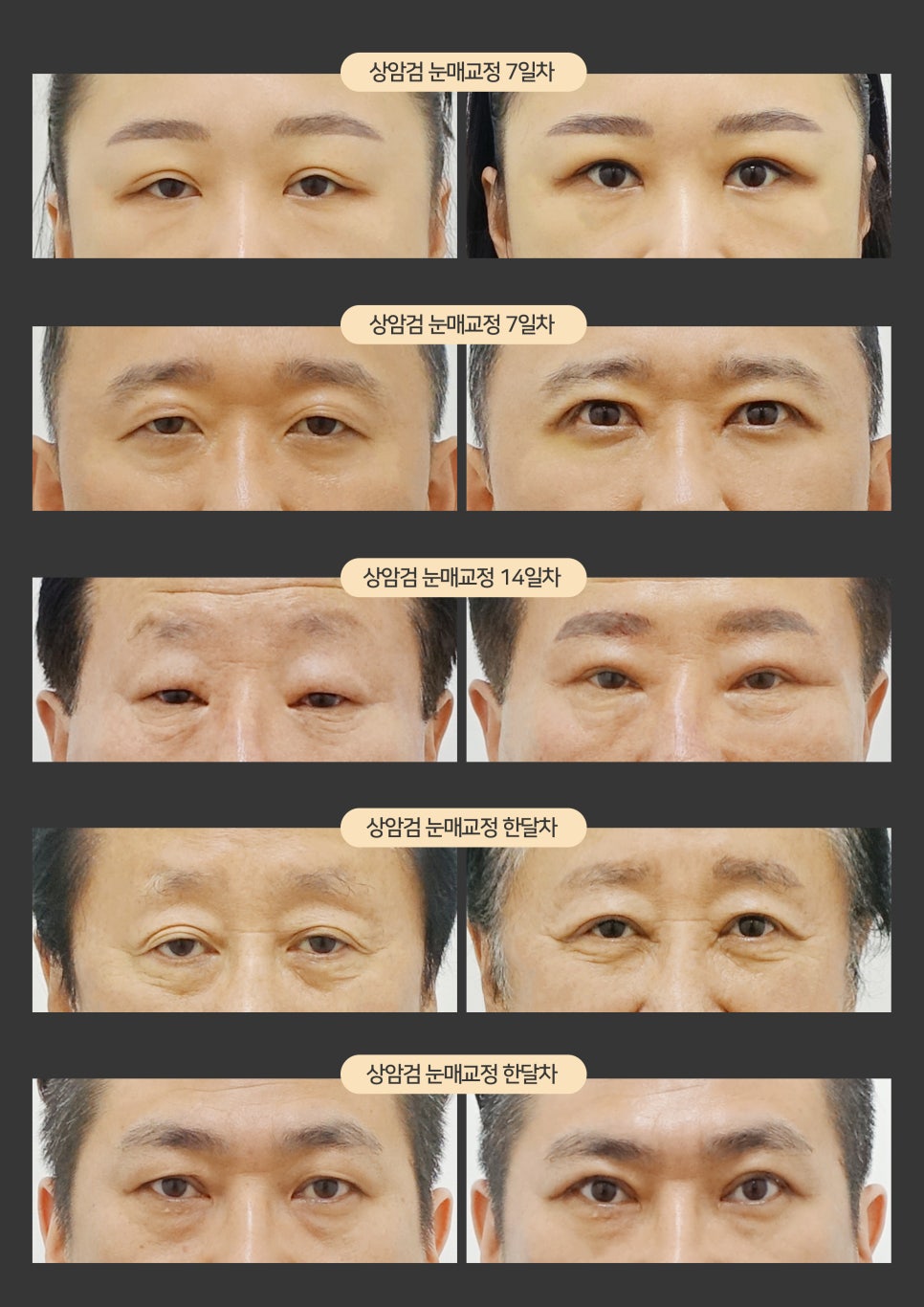 [잠실동성형외과] 결과로 증명하는 눈매교정 맛집! 매력적이게! 잠실성형외과 관련 이미지 4