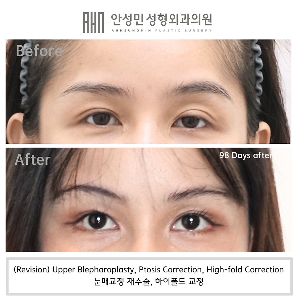 소세지눈 쌍꺼풀 풀기 재수술로 해결 관련 이미지 6
