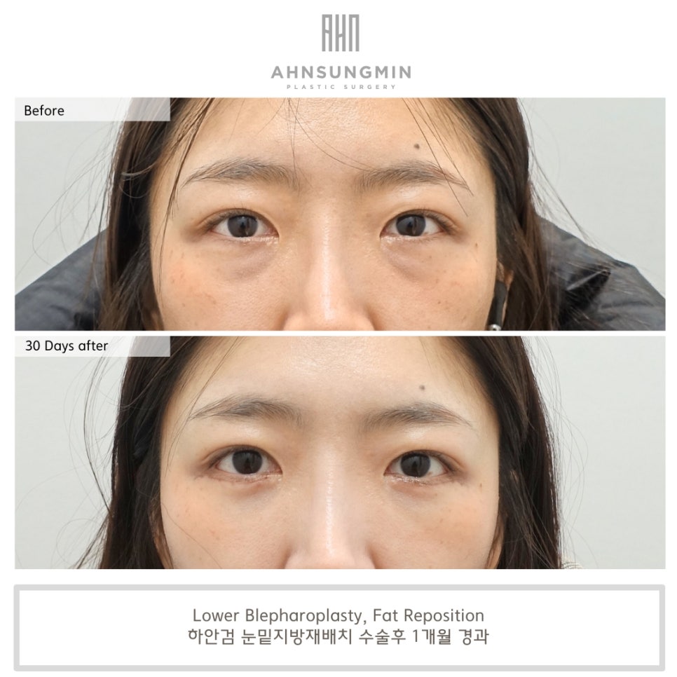 하안검 수술을 통한 눈밑지방재배치 [성형외과 전문의 안성민] 관련 이미지 2