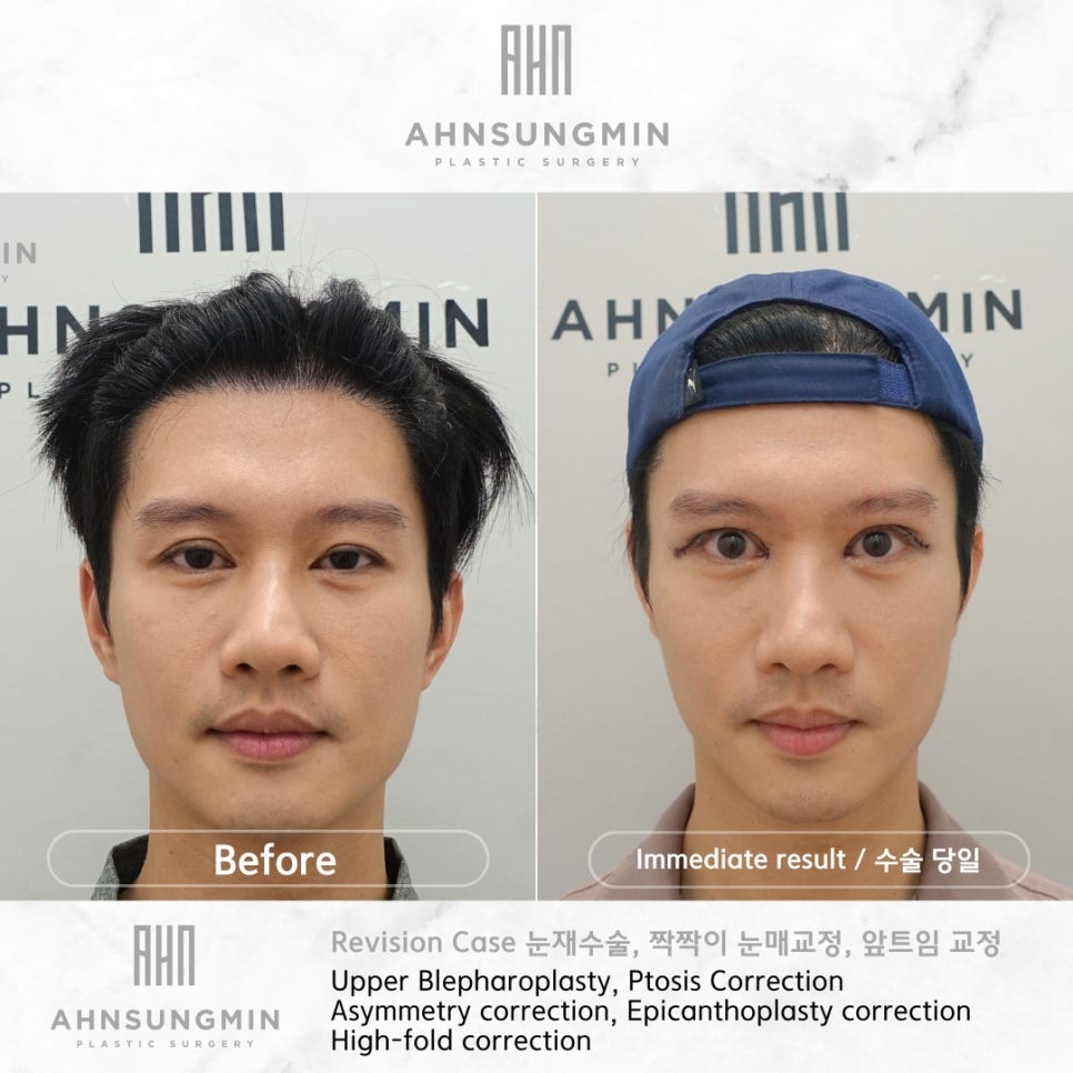 남자 쌍꺼풀 재수술 눈매교정, 짝짝이 교정 잘하는 곳 안성민성형외과 관련 이미지 6