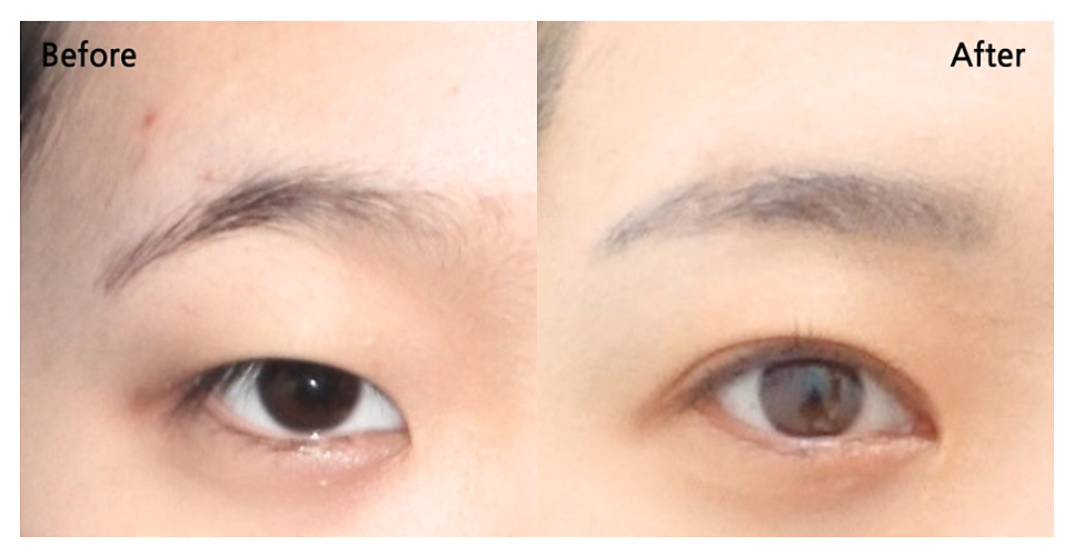 앞트임 수술이란? 내안각 교정술 Epicanthoplasty, 몽고주름 앞트임 성형술 관련 이미지 5