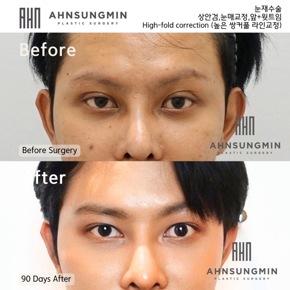 재수술 남자 하이폴드 교정수술 [높은 라인 교정 재수술] High-fold correction 안성민원장 관련 이미지 3