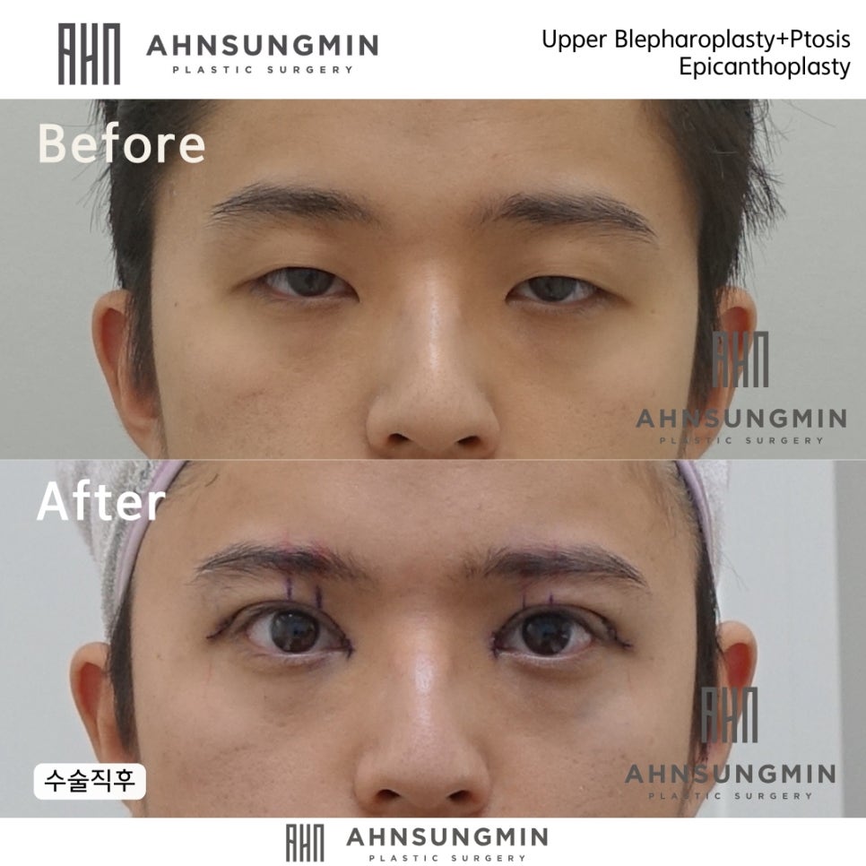 남자 안검하수 눈매교정, 20대 남자에게 어울리는 눈매교정 관련 이미지 3