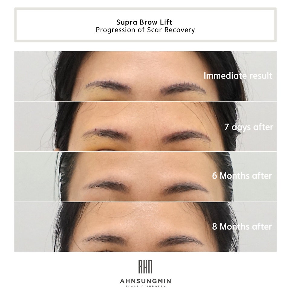 눈썹 거상 수술 효과와 흉터 변화 관련 이미지 4