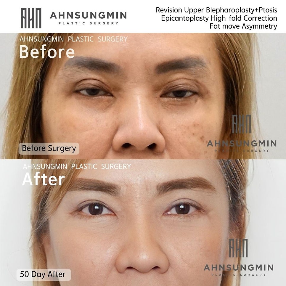 눈재수술전문 재수술이 어려운 이유 관련 이미지 2