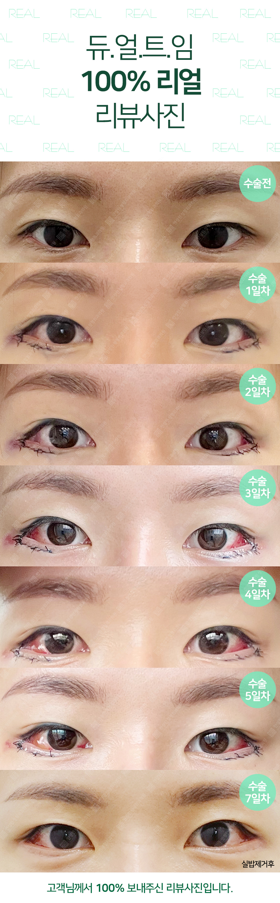 [잠실동성형외과] 티나는 트임은 이.제.그.만! 듀얼트임으로 크고시원한눈!(실밥사진포함) / 잠실성형외과 관련 이미지 2