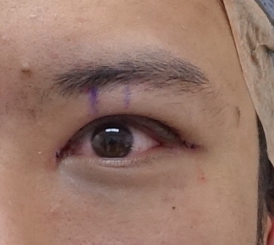 생기있는 남자 눈매완성, 안검하수 눈매교정 관련 이미지 4