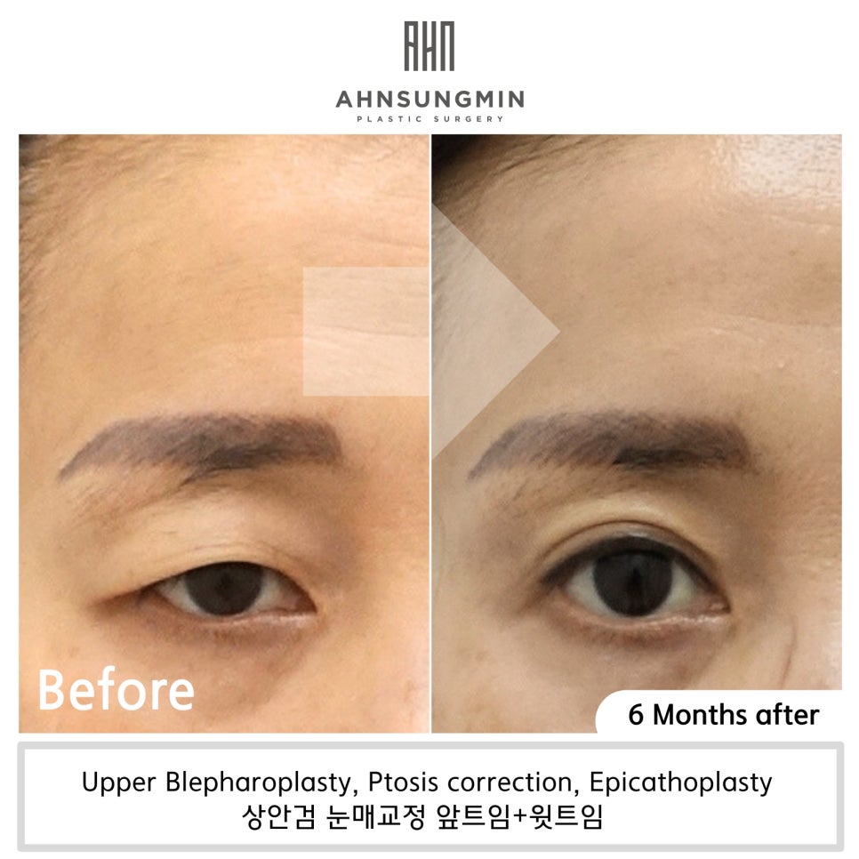 눈매교정 수술 후 6개월 경과 관련 이미지 2