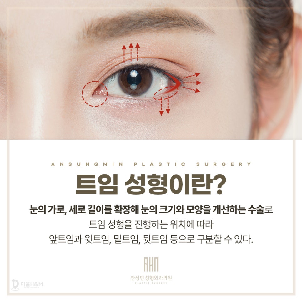 송파구 성형외과 트임성형 후기 많은 이유 관련 이미지 2