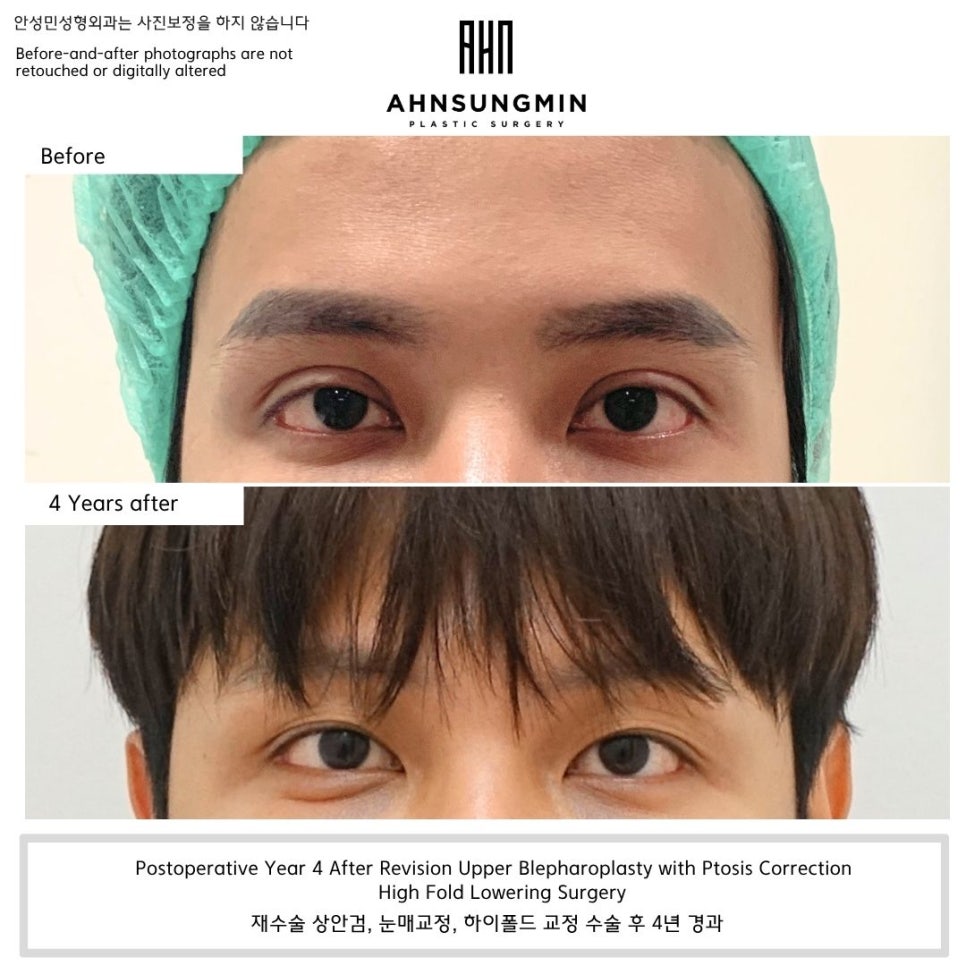 소세지눈 때문에 고민이셨나요? 쌍꺼풀을 낮추고 자연스러운 남성 눈매를 되찾은 4년 후 사례 관련 이미지 2