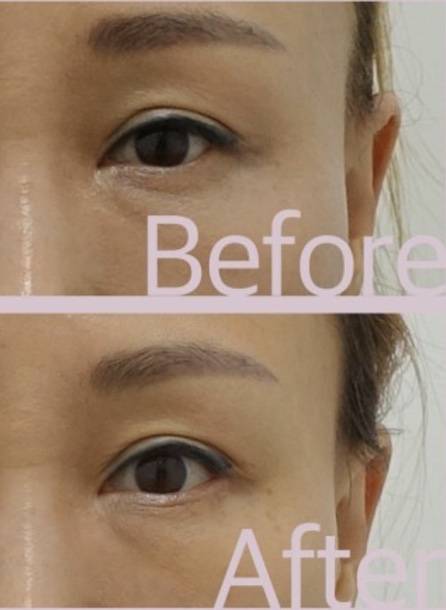 뒷트임 뒷내림 시원하고 선해 보이는 눈매교정 관련 이미지 3