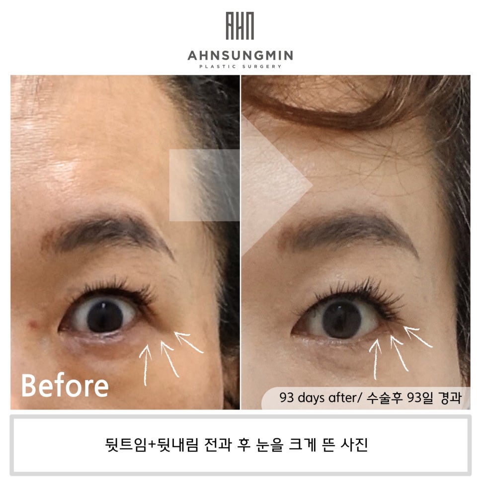 뒷트임 후 눈뜨기가 쉬워요 [성형외과 전문의 안성민] 관련 이미지 10