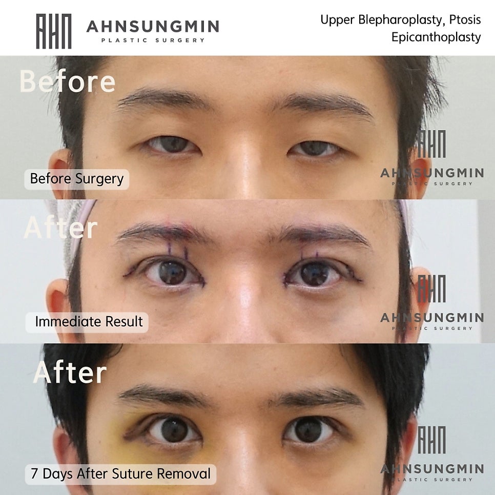 20대 남성 안검하수 눈매교정이 필요한 이유 관련 이미지 2