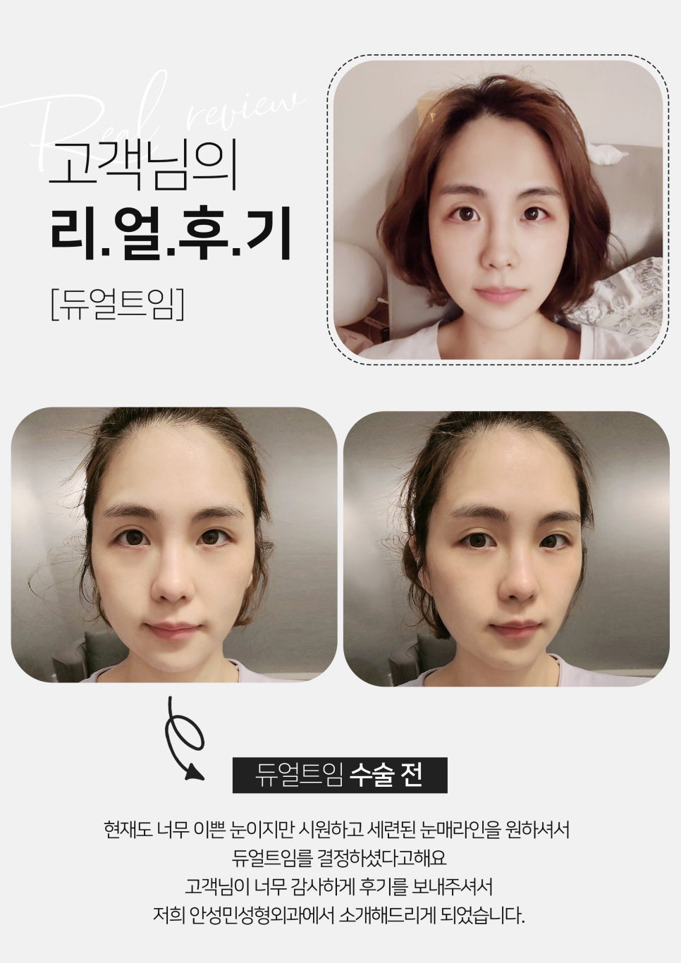 [잠실동성형외과] 듀얼트임 고객님의 리얼후기! 성형후기! 뚜렷한 눈매를 원한다면? 잠실 안성민성형외과! 관련 이미지 1