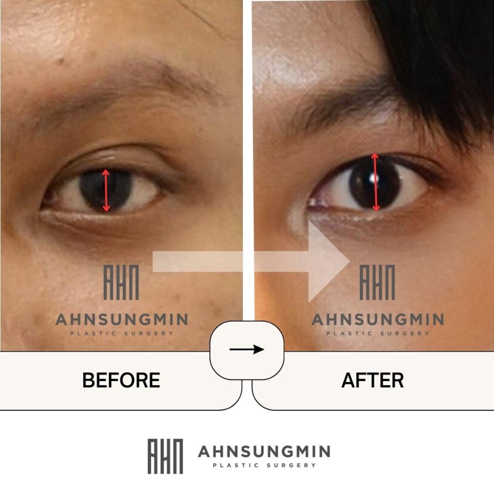 재수술 남자 하이폴드 교정수술 [높은 라인 교정 재수술] High-fold correction 안성민원장 관련 이미지 2