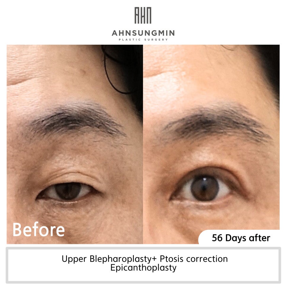 눈매교정 수술이 필요한이유 눈매교정 전문 안성민성형외과 관련 이미지 2