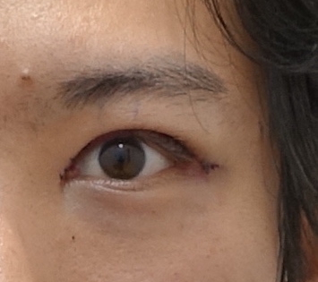 생기있는 남자 눈매완성, 안검하수 눈매교정 관련 이미지 5