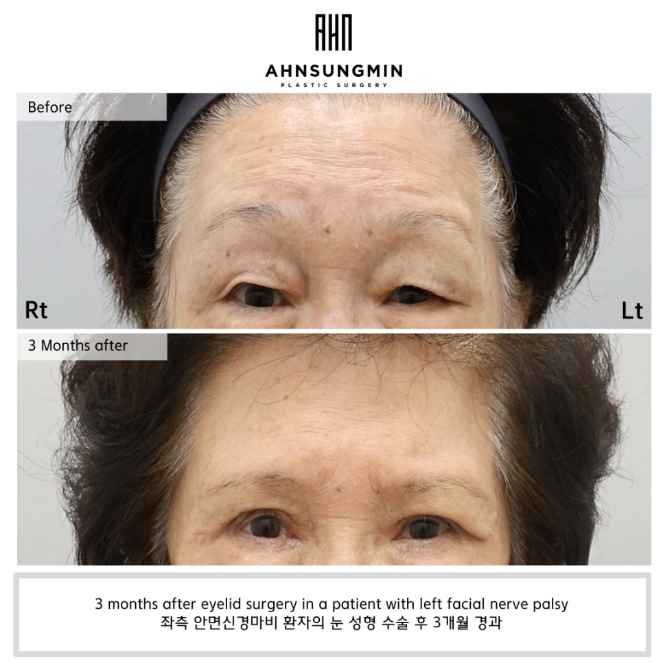 안면신경마비 환자의 눈 성형, 수술의 핵심은 &lsquo;대칭&rsquo; 관련 이미지 1