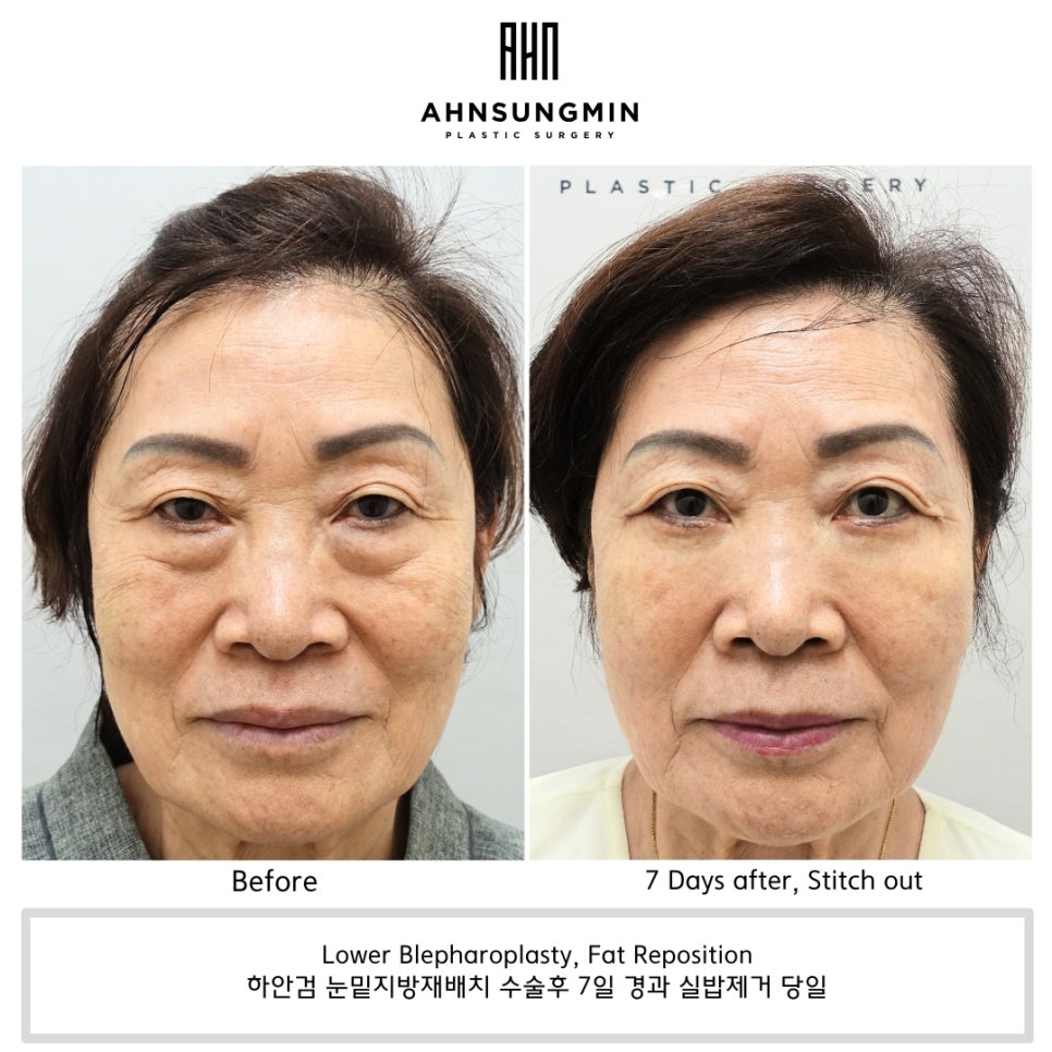 70대 여성 하안검 노화 과정에 따른 하안검 수술 주의점 관련 이미지 1