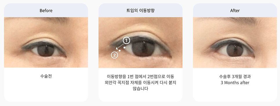 트임 성형의 모든 것 뒤트임, 뒷내림, 밑트임 관련 이미지 2