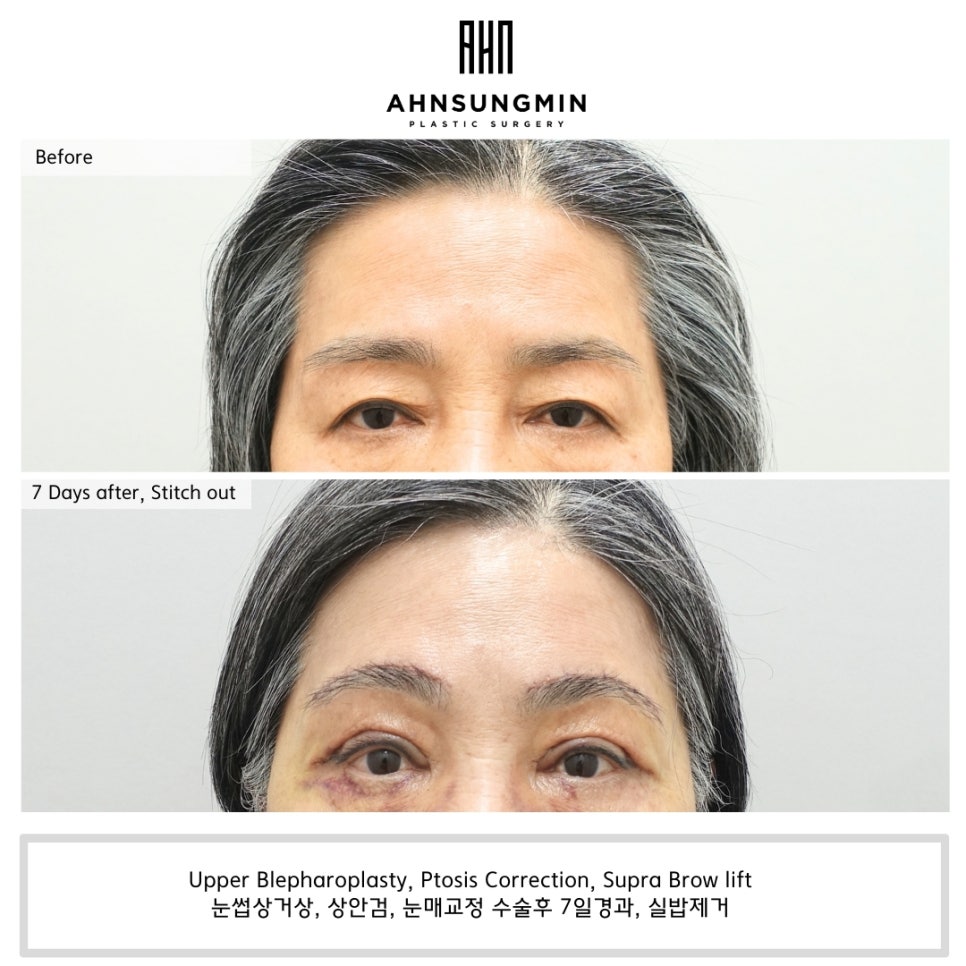 눈썹거상 수술과 상안검 수술의 차이점 관련 이미지 1
