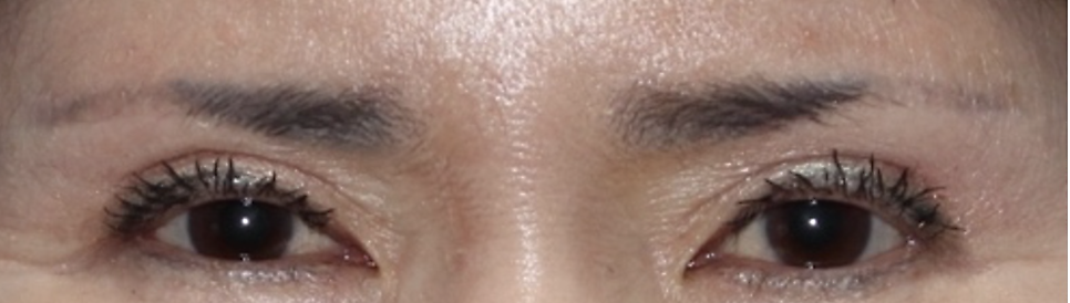 눈꺼풀 처짐을 해결하는 방법, 눈썹 거상 수술이 필요한 경우 관련 이미지 4