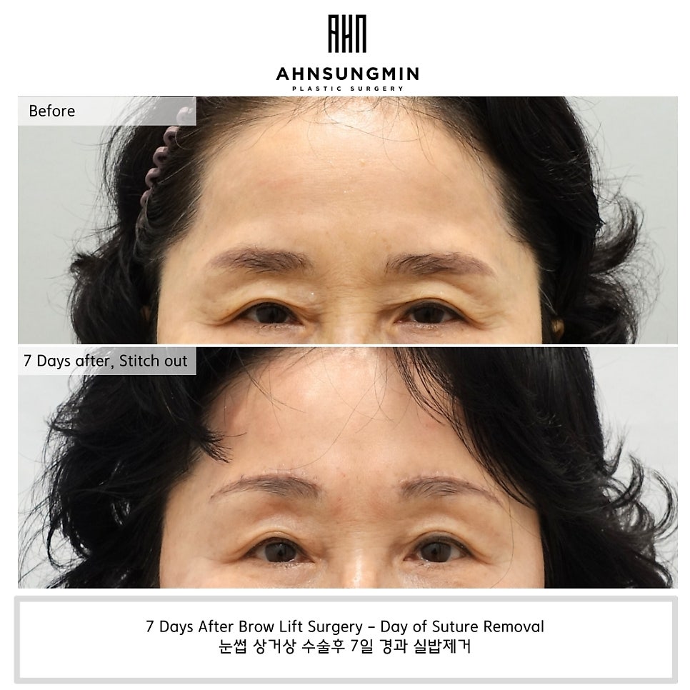 60대 눈썹상거상술 전후 비교, 눈이 편안해진 이유 관련 이미지 2