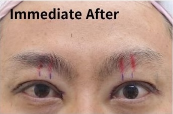 쌍꺼풀 재수술 후 눈은 언제 자연스러워질까? (Day 1부터 6개월 변화) 관련 이미지 3
