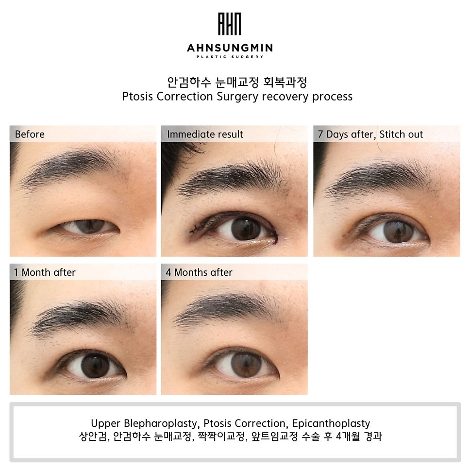 [4개월 경과] 남자 안검하수 수술의 핵심 포인트!! 관련 이미지 4