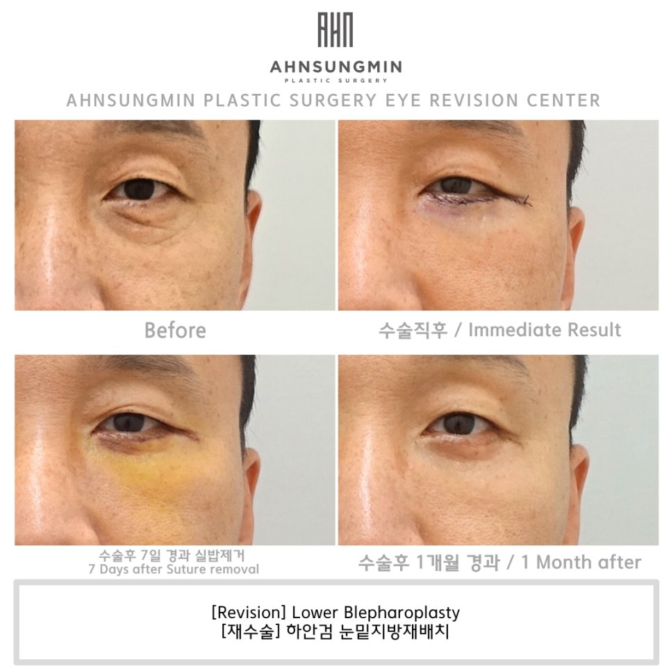 하안검 재수술 상담 [성형외과 전문의 안성민] 관련 이미지 3