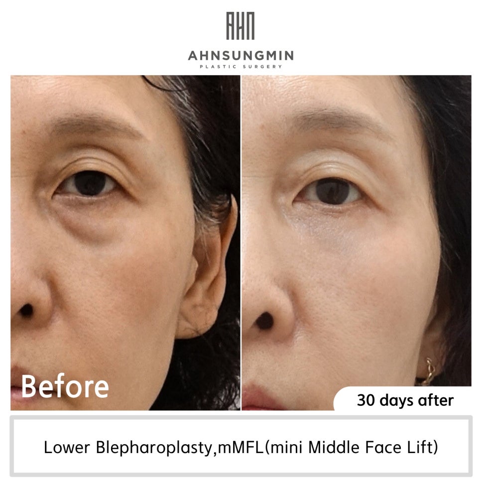 하안검 눈밑지방재배치란 무엇일까요? [지방제거를 하면 안 되는 이유] 관련 이미지 7