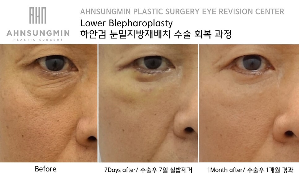 하안검 재수술 잘하려면 [성형외과 전문의 안성민] 관련 이미지 5
