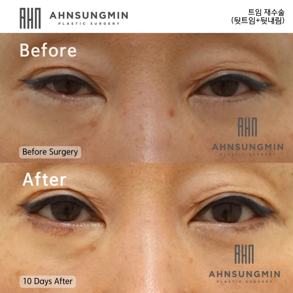 뒷트임 복원 뒷트임 재수술 시기 [뒷트임과 뒷내림] 관련 이미지 2