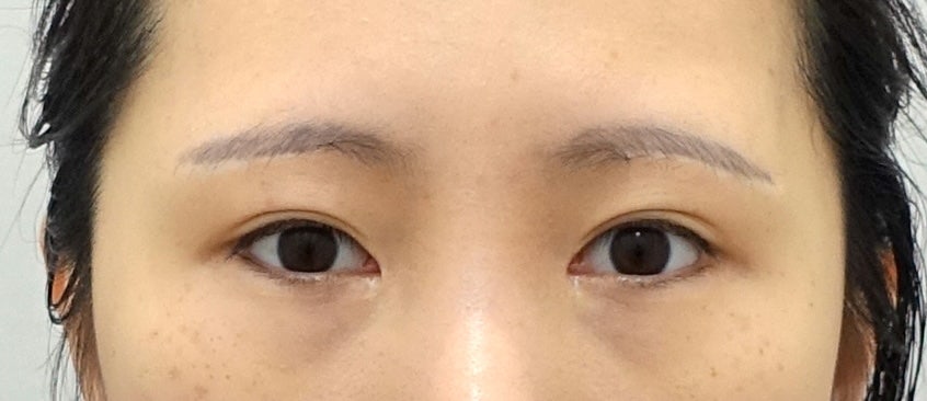 눈썹 상거상 수술이 필요한 이유와 눈썹 하거상 수술의 부작용 관련 이미지 6
