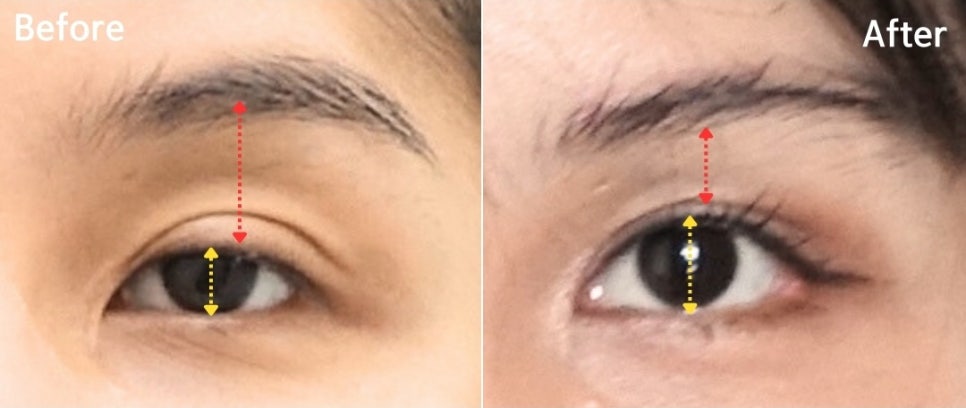 소세지눈 쌍꺼풀 풀기 재수술로 해결 관련 이미지 7