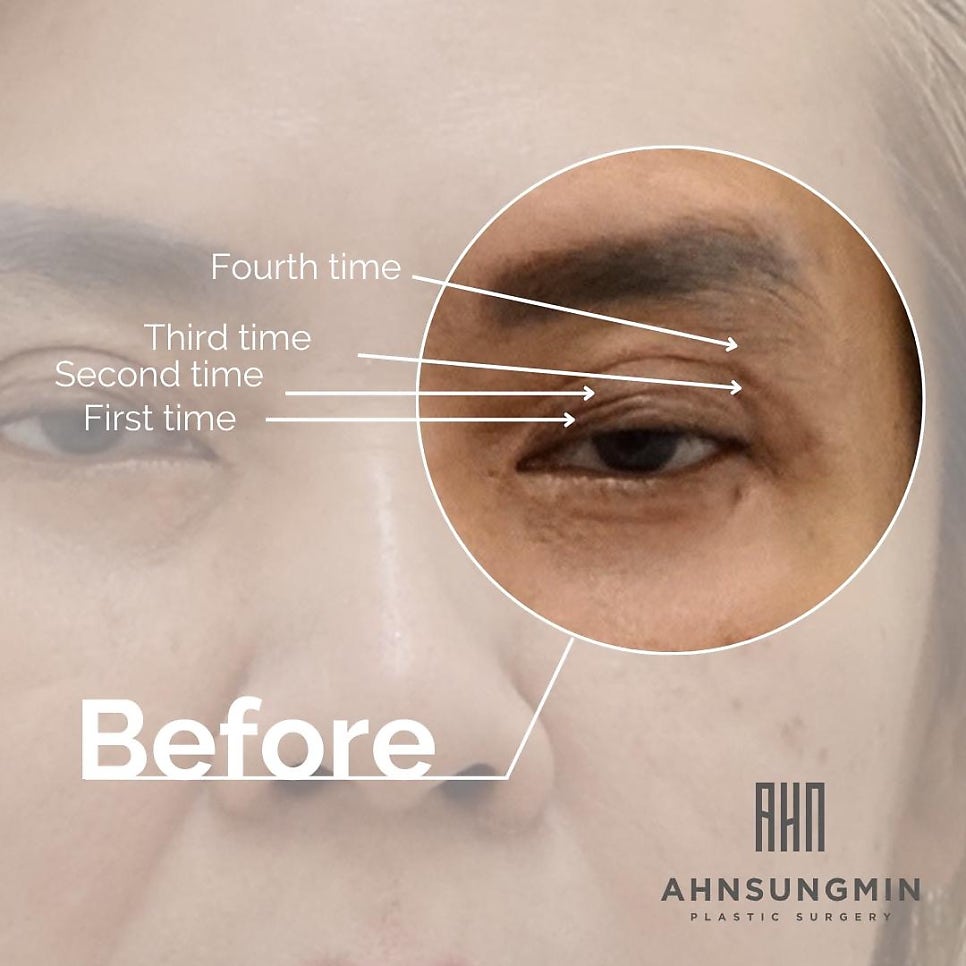 눈재수술전문 재수술이 어려운 이유 관련 이미지 3