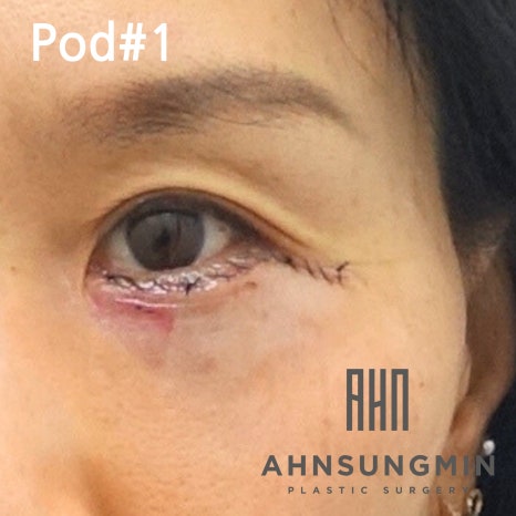 중년의 눈밑지방재배치 수술과 회복 과정 알아보기 관련 이미지 4