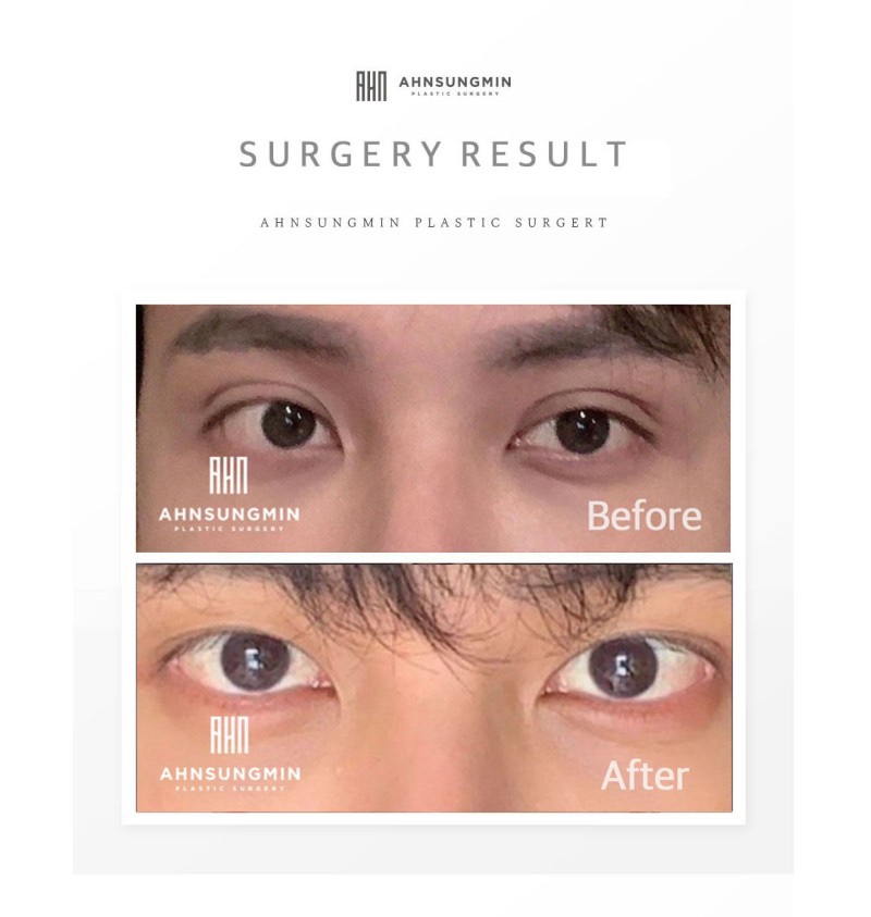 남자 눈재수술 매력적인 무쌍 눈매교정 관련 이미지 5