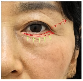 하안검 지방재배치 재수술, 정말 가능한가요? 관련 이미지 2