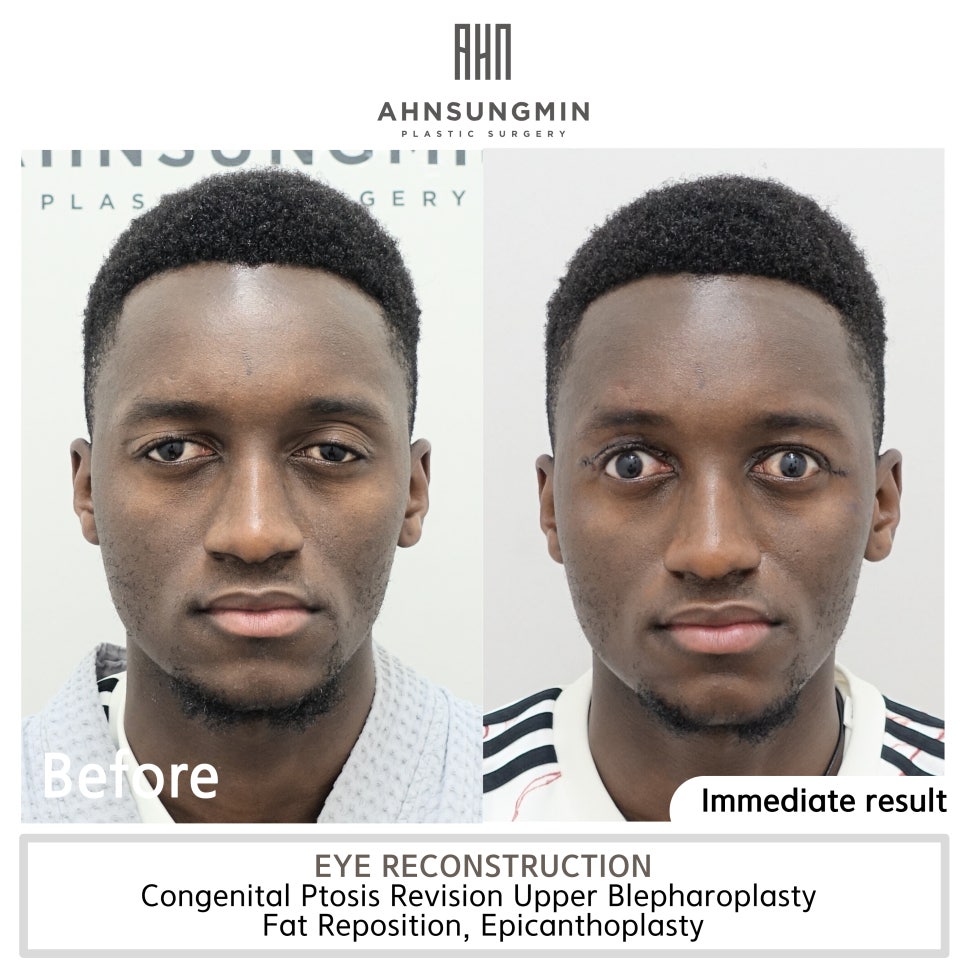 선천성 안검하수 재수술 짝짝이교정 관련 이미지 3