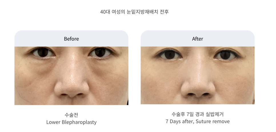 불룩한 눈 밑 지방, 해결할 수 있을까? 관련 이미지 7