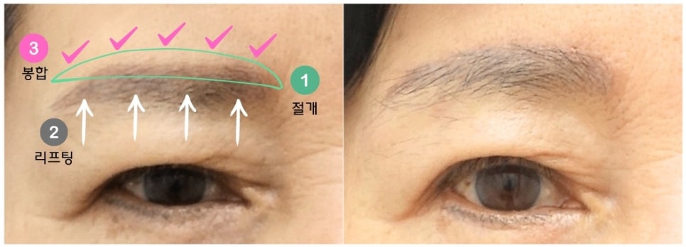 눈꺼풀 처짐을 해결하는 방법, 눈썹 거상 수술이 필요한 경우 관련 이미지 2