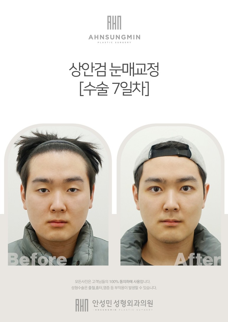 "눈매교정" 무엇일까? 관련 이미지 3